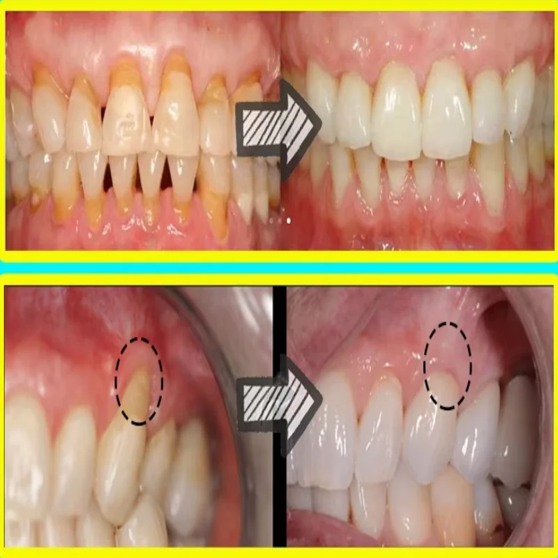Soro de goma para reparação rá - Teeth Whitening With Baking Soda avaliação e preço