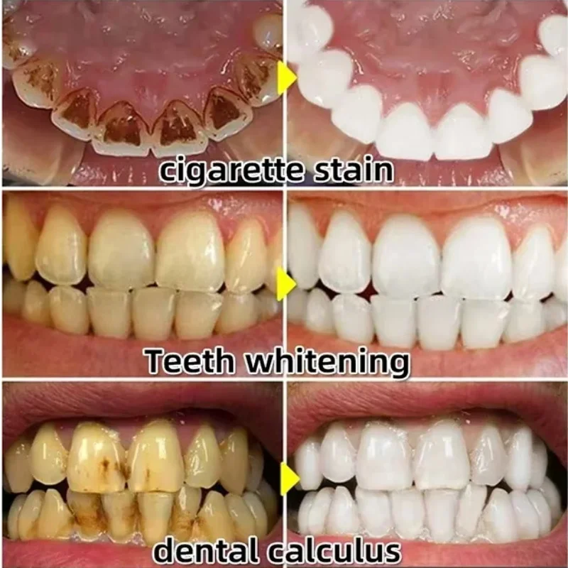 Soro de goma para reparação rá - Teeth Whitening With Baking Soda avaliação e preço