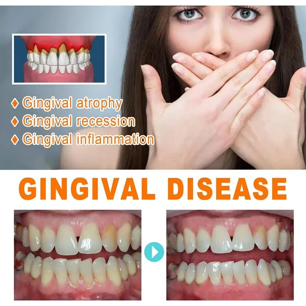 Soro de goma para reparação rá - Teeth Whitening With Baking Soda avaliação e preço