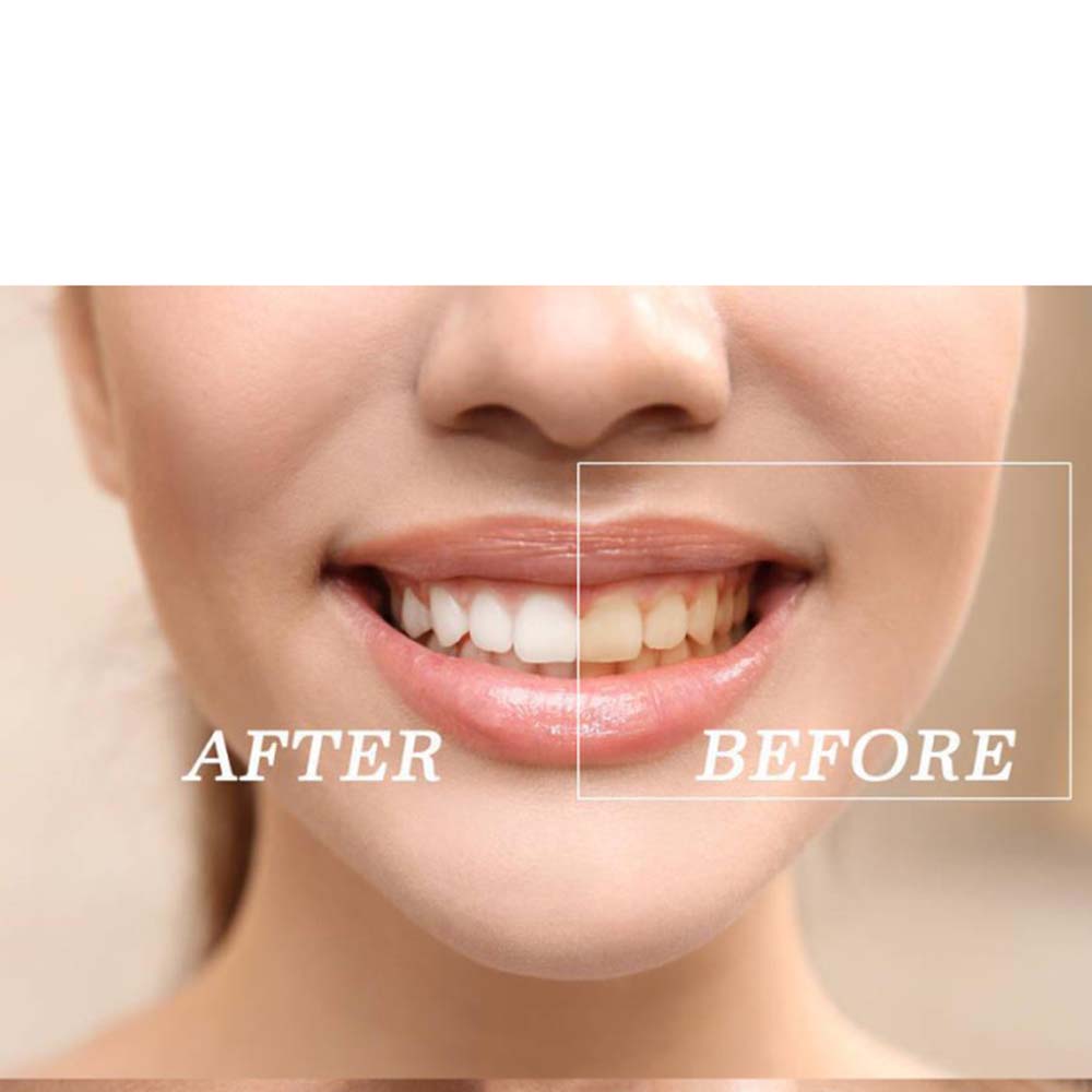 Kit de gel para clareamento de - Teeth Whitening (Bleaching) avaliação e preço