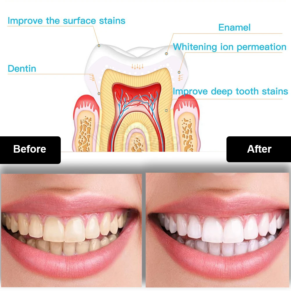 Kit de clareamento dental dos  - Teeth Whitening Q&M avaliação e preço