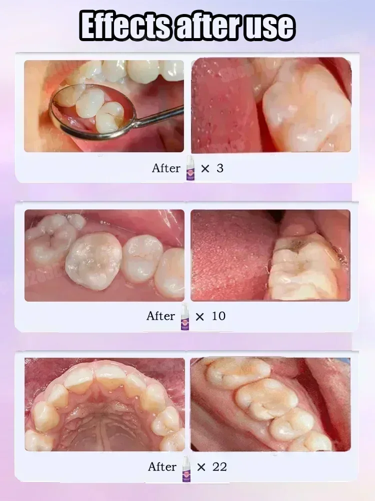 Pasta de Dente para Limpeza De - Teeth Whitening Treatment avaliação e preço